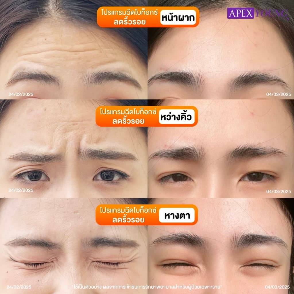 APEX โปรแกรมBo โบท็อกซ์ ลดกราม ลดริ้วรอย ลิฟต์กรอบหน้า 50U + ultraformer หน้าเรียว X2 รูปที่ 4
