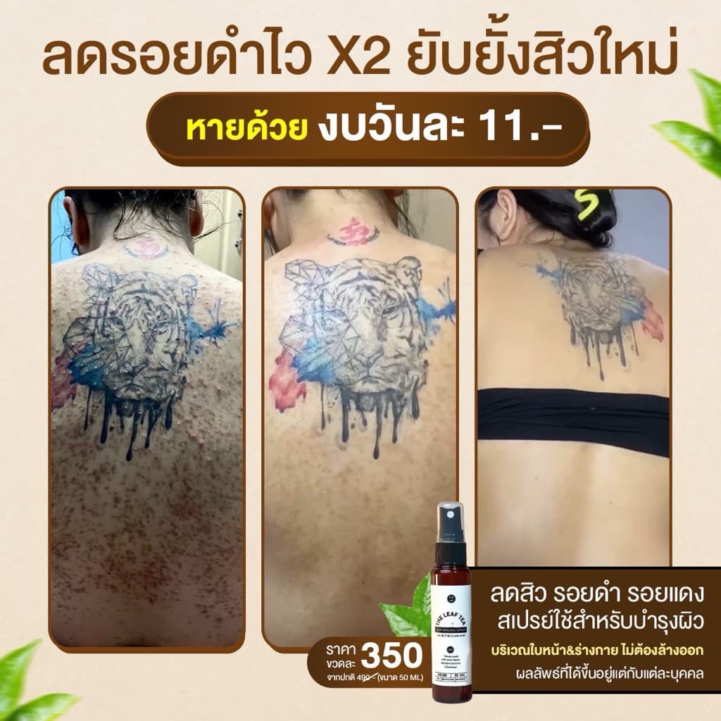 สเปรย์รักษาสิวที่หลัง สิวหน้าอก สิวใบหน้า สูตรแพทย์แผนไทย สเปรย์รักษารอยดำหลัง สเปรย์ใบชา รูปที่ 1