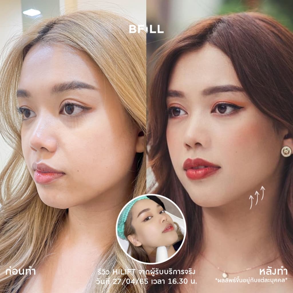โปรแกรม Hi Lift ไฮลิฟท์ by Specialist ลดแก้มป่อง, กรอบหน้าชัด | BFiLL Clinic บีฟิล คลินิก รูปที่ 4