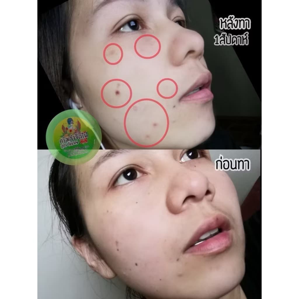 ครีมกำจัดไฝ จีจี้ รูปที่ 7