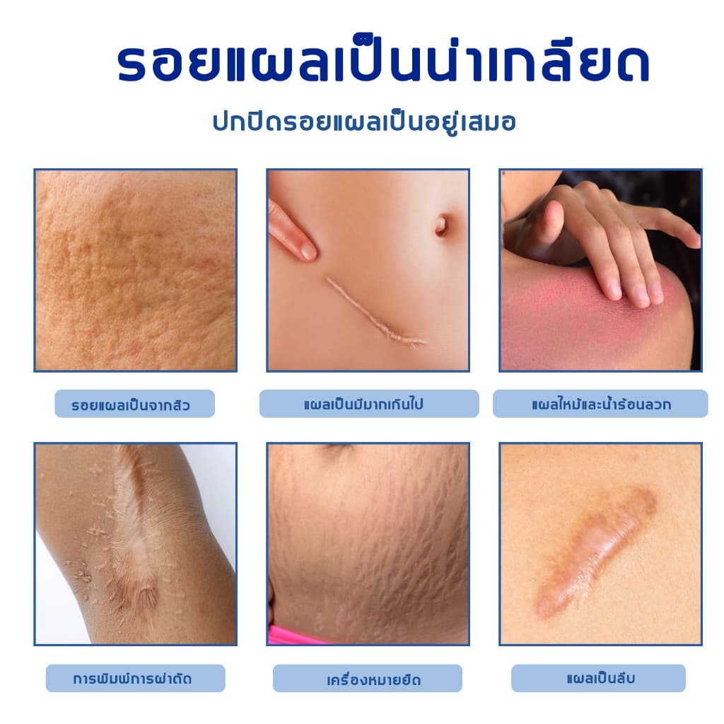 ลบรอยแผลเป็นสีดำ ลดรอยแผลเป็น ปรับปรุงรอยแผลเป็นนูนและแผลไฟไหม้ ให้ผิวเรียบเนียนและสุขภาพดีขึ้น รูปที่ 3