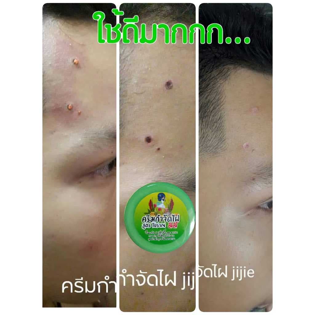ครีมไฝจีจี้ ขี้แมลงวัน ติ่งเนื้อ หูด ตาปลา แก้ปัญหา กระ สิวหิน ครีมแต้มไฝจีจี้ไฝ หูด จี้ไฝ แต้มไฝ หูดติ่งเนื้อ รูปที่ 7