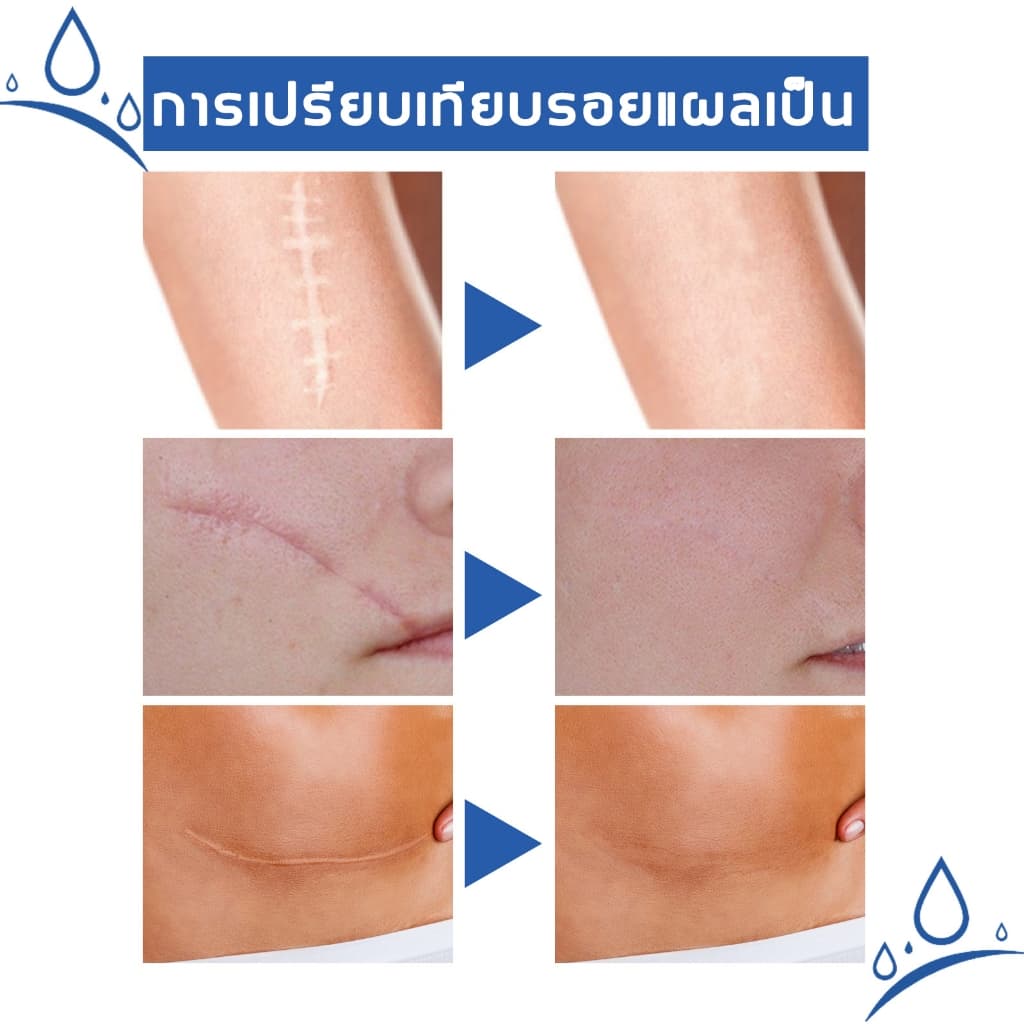 ลบรอยแผลเป็นสีดำ ลดรอยแผลเป็น ปรับปรุงรอยแผลเป็นนูนและแผลไฟไหม้ ให้ผิวเรียบเนียนและสุขภาพดีขึ้น รูปที่ 2