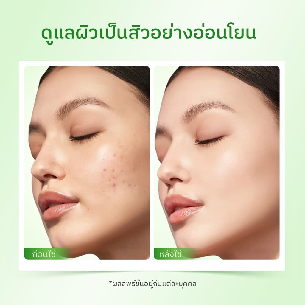 The originote Hyalu-C Mugwort B3 Clay Stick Mask ช่วยรักษาสิว ช่วยให้ผิวดูกระจ่างใสขึ้น พร้อมลดความหมองคล้ำ รูปที่ 6