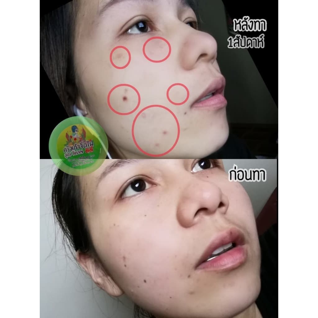 ครีมไฝจีจี้ ขี้แมลงวัน ติ่งเนื้อ หูด ตาปลา แก้ปัญหา กระ สิวหิน ครีมแต้มไฝจีจี้ไฝ หูด จี้ไฝ แต้มไฝ หูดติ่งเนื้อ รูปที่ 2