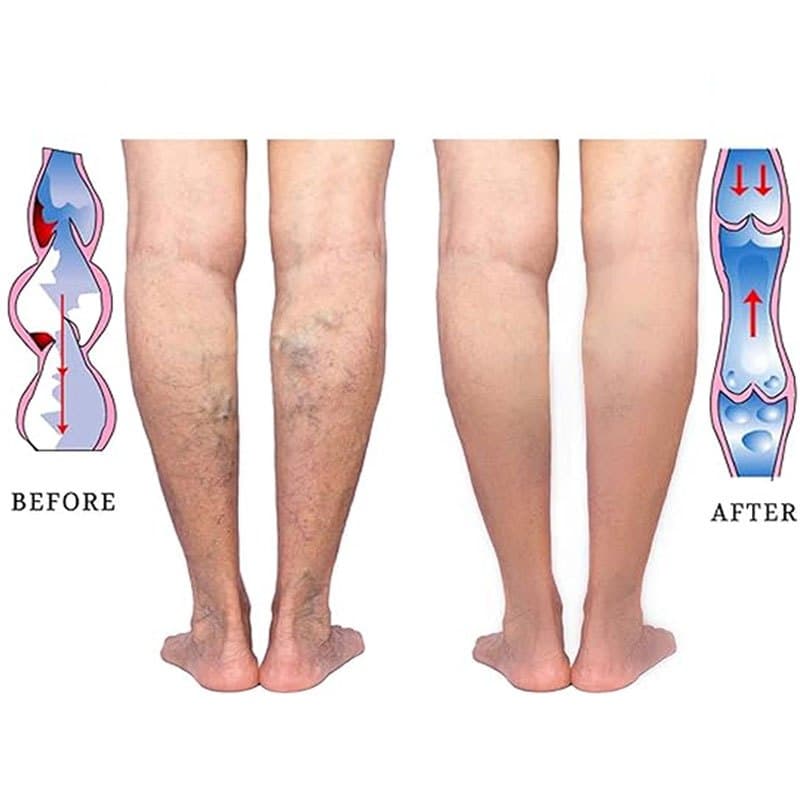 1คู่ เส้นเลือดขอด ถุงเท้าเส้นเลือดขอด เนื้อหนา ถุงน่องบีบอัด Compression Socks รูปที่ 6