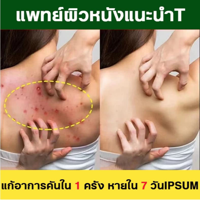 ครีมแก้คันผิว ลดผื่นคัน บรรเทาอาการคัน ฆ่าเชื้อรา ฟื้นฟูผิว เห็นผลไว 20G รูปที่ 3