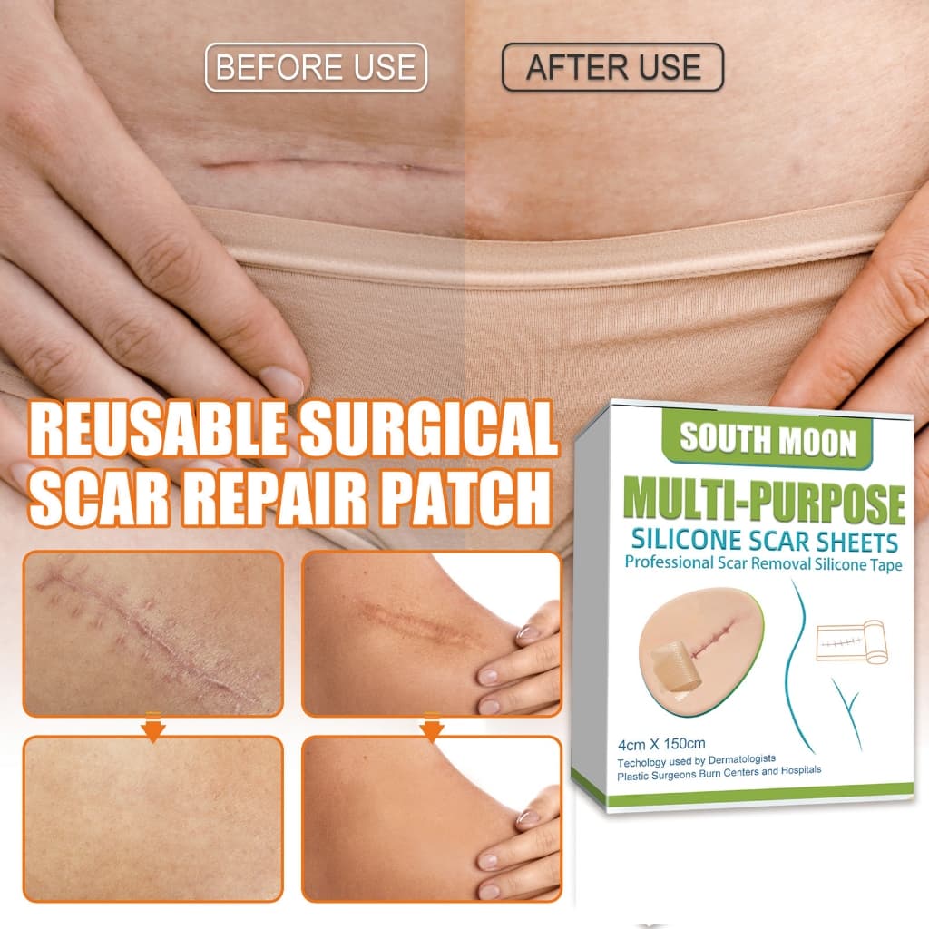 South Moon silicone scar sheet รักษารอยแผลเป็น แผ่นแปะแผลเป็น กําจัดรอยแผลเป็นจากแผลเป็น เผยผิวเนียนสวย รูปที่ 4