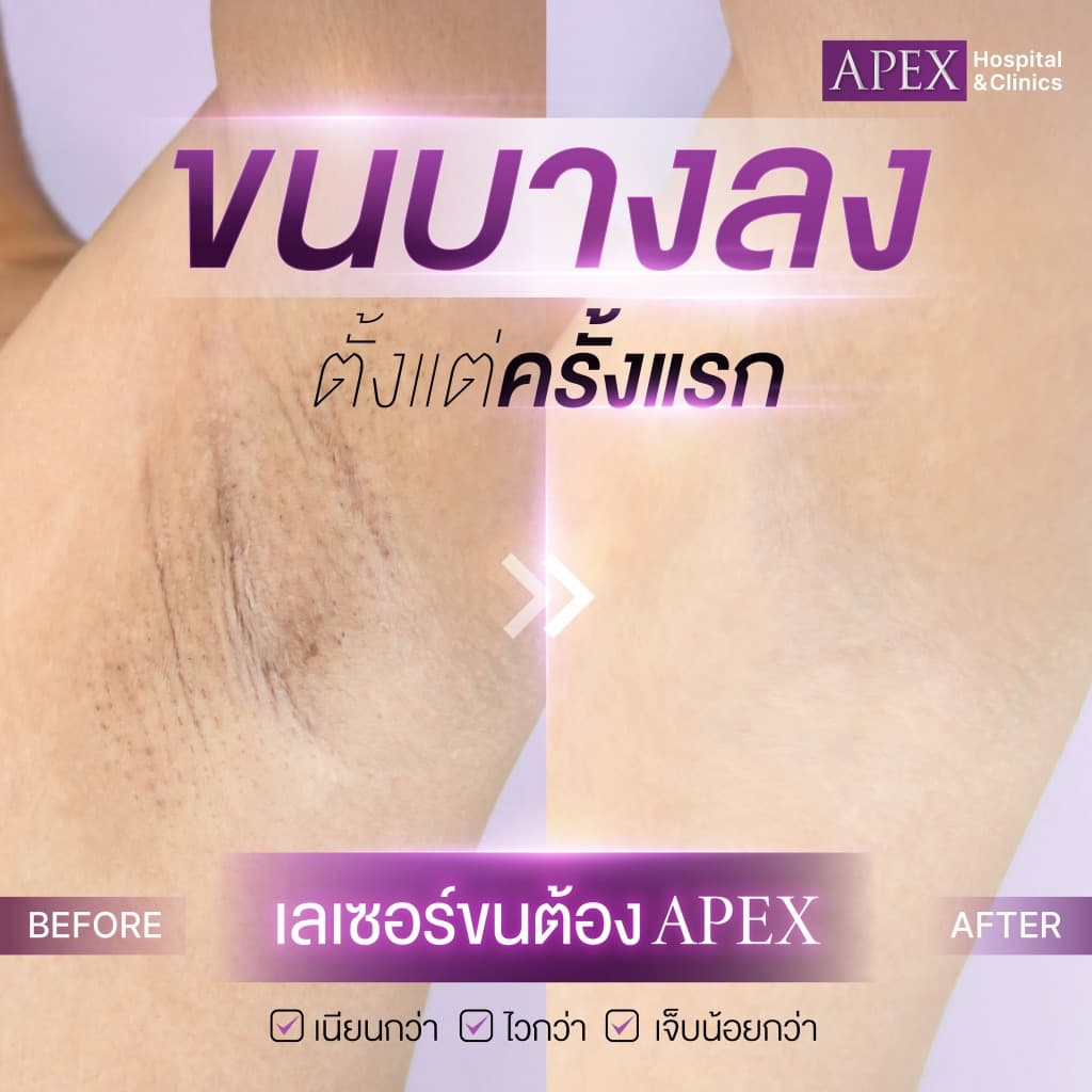 APEX เลเซอร์กำจัดขน กำจัดขนรักแร้ โปรพิเศษ 10 ครั้ง/1 ปี X3 พลังเลเซอร์ เครื่องกำจัดขน เห็นผลไว ยิงลึก รูปที่ 7