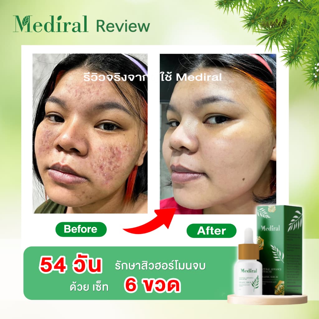 เมดิรอล เซรั่มลดสิวMediral ตัดวงจรสิวซ้ำซาก ฆ่าเชื้อสิวใน7วันดีขึ้น ผิวแข็งแรง ออร์แกนิก รูปที่ 8