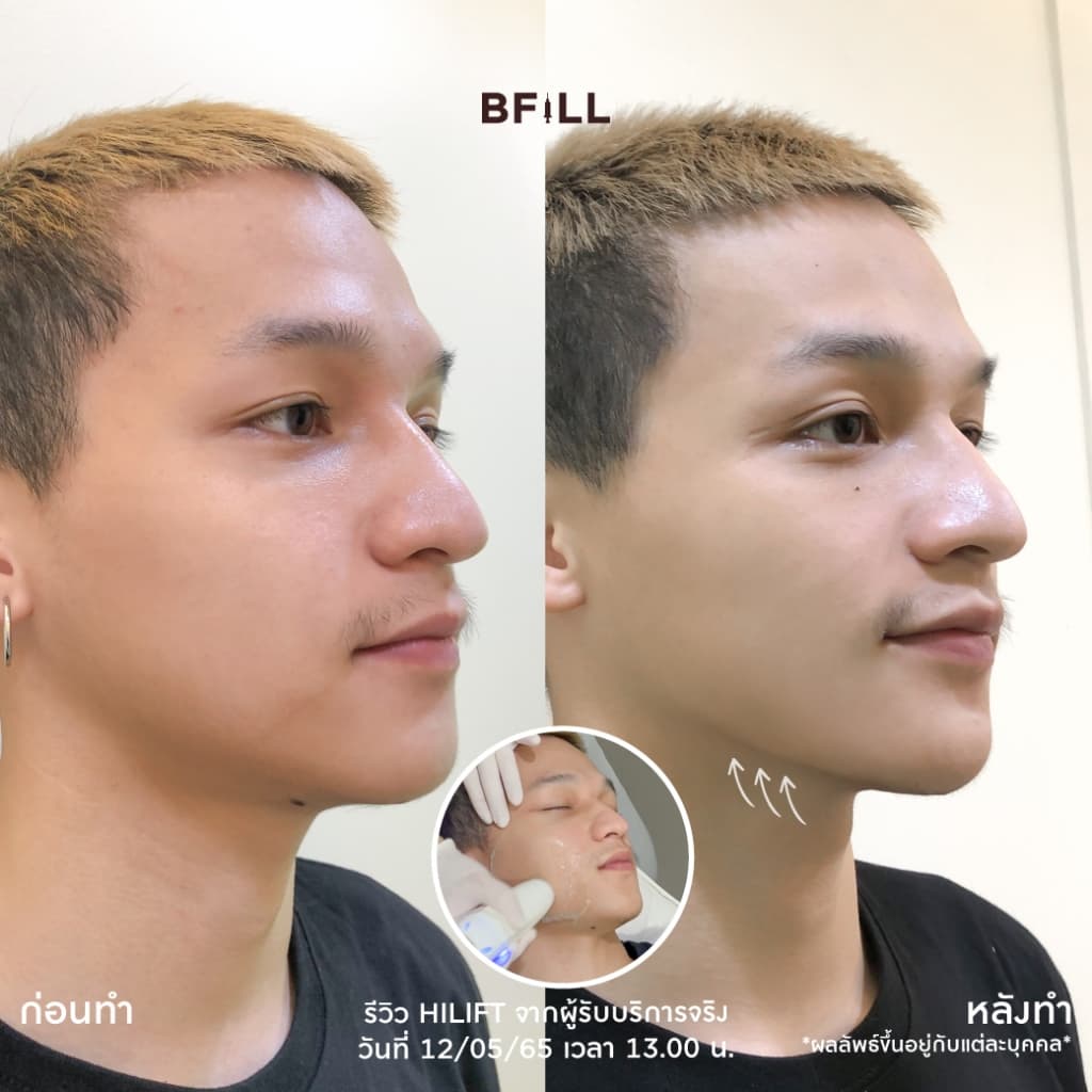 โปรแกรม Hi Lift ไฮลิฟท์ by Specialist ลดแก้มป่อง, กรอบหน้าชัด | BFiLL Clinic บีฟิล คลินิก รูปที่ 7