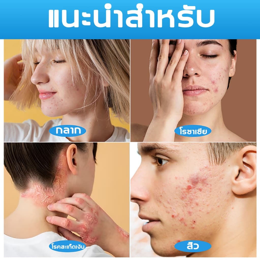 ครีมบำรุงผิว สำหรับผิวคัน ระคายเคือง ผื่น แพ้ ผิวอักเสบ กลาก ผิวบอบบาง อ่อนโยน ส่วนผสมจากธรรมชาติ บำรุงและปกป้องผิว รูปที่ 3