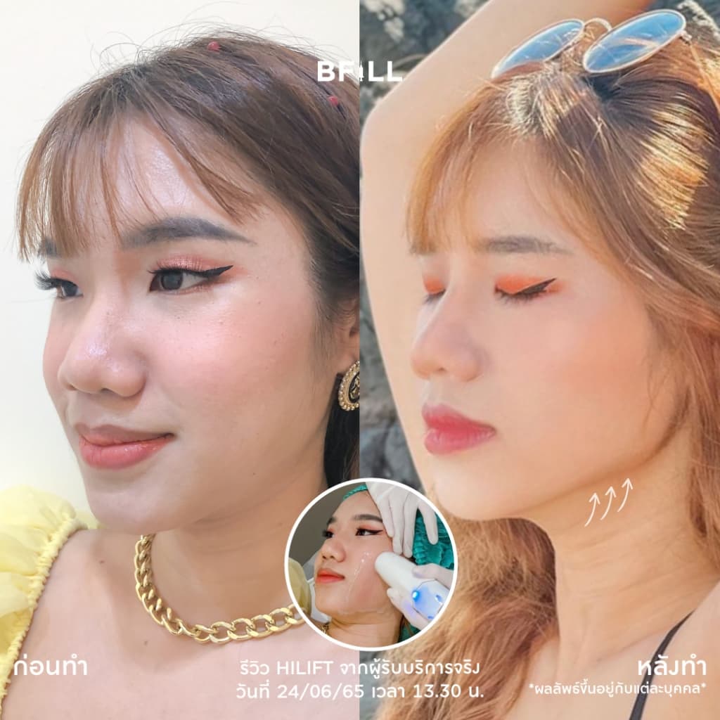 โปรแกรม Hi Lift ไฮลิฟท์ by Specialist ลดแก้มป่อง, กรอบหน้าชัด | BFiLL Clinic บีฟิล คลินิก รูปที่ 5