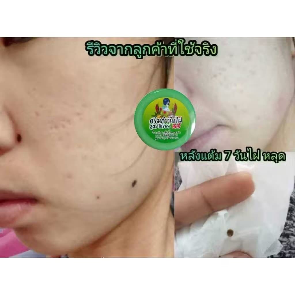 ครีมกำจัดไฝ จีจี้ รูปที่ 8