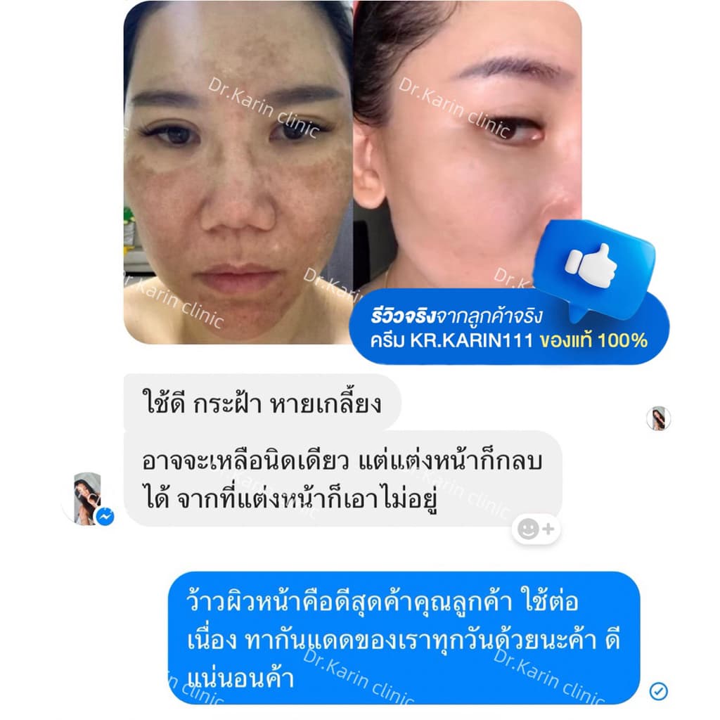 SET D | KARIN111 – เซตครีมการิน สูตรคลินิก ขนาด 5g x 3 ตลับ รูปที่ 4