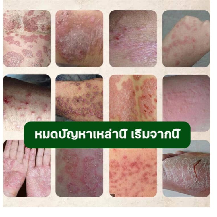 ครีมแก้คันผิว ลดผื่นคัน บรรเทาอาการคัน ฆ่าเชื้อรา ฟื้นฟูผิว เห็นผลไว 20G รูปที่ 2