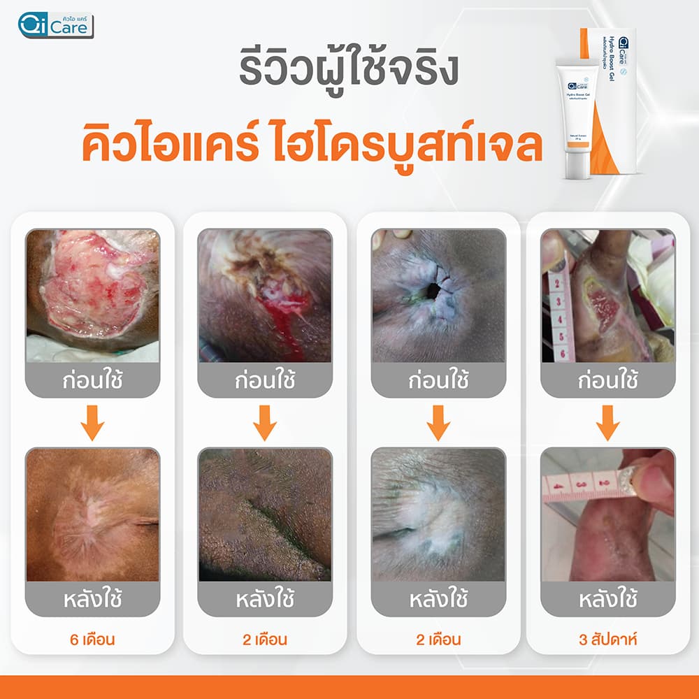 คิวไอเจล เจลสมุนไพรทาแผลกดทับ แผลเบาหวาน แผลเรื้อรัง ขนาด 20 กรัม รูปที่ 6
