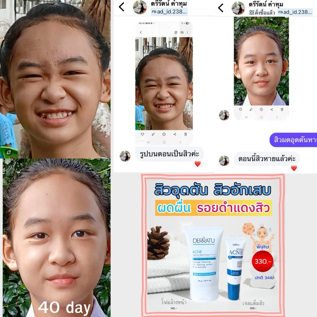 ชุดสิวหายด่วน DERRATU สิวอุดตัน สิวอักเสบ รอยดำสิว รูปที่ 9