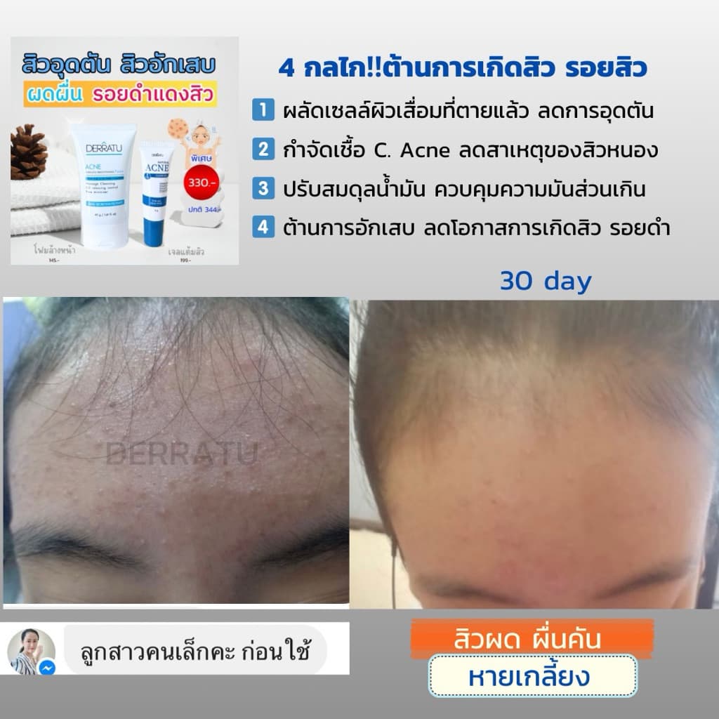 ชุดสิวหายด่วน DERRATU สิวอุดตัน สิวอักเสบ รอยดำสิว รูปที่ 8