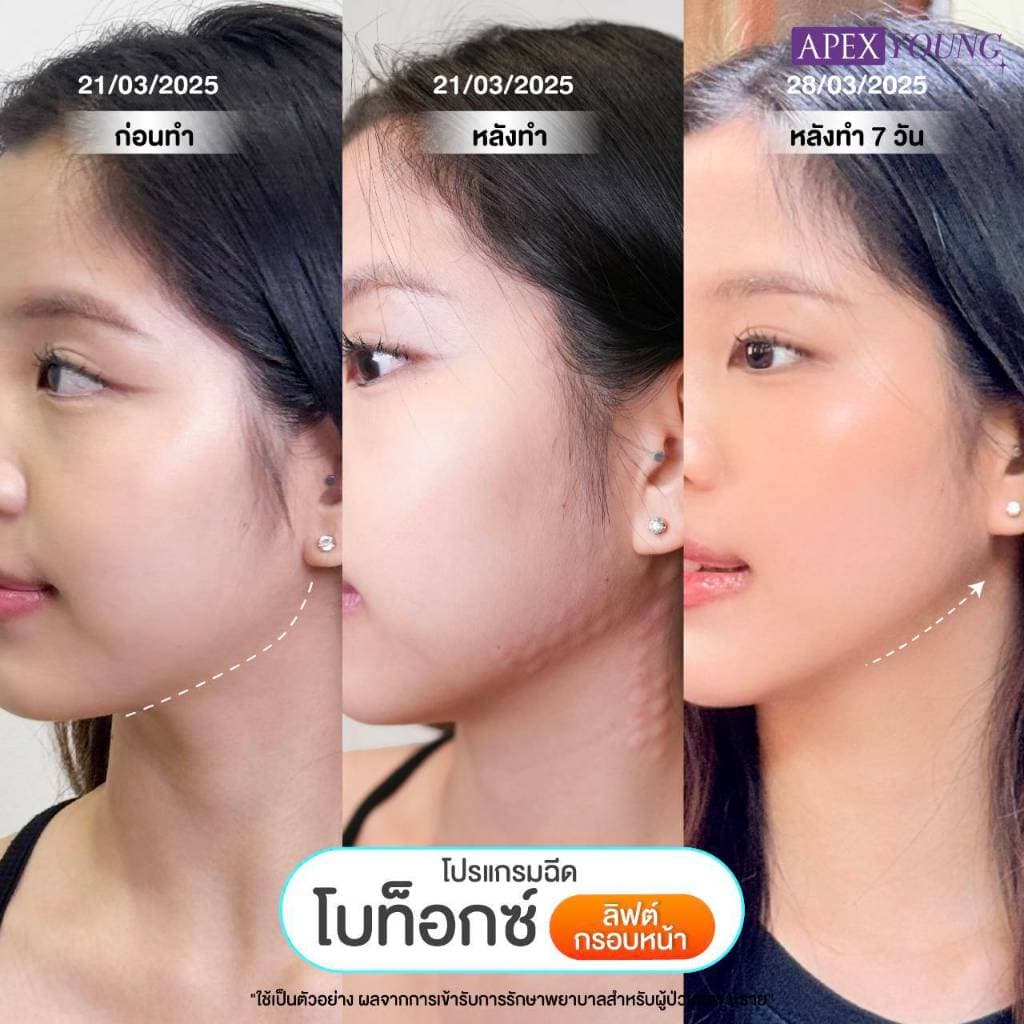 APEX โปรแกรมBo โบท็อกซ์ ลดกราม ลดริ้วรอย ลิฟต์กรอบหน้า 50U + ultraformer หน้าเรียว X2 รูปที่ 2
