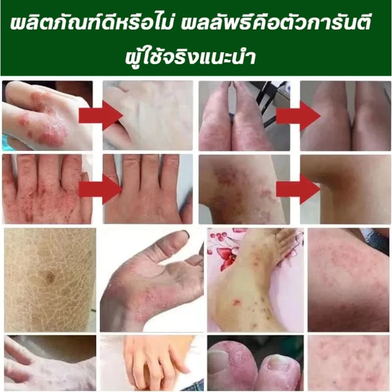 ครีมแก้คันผิว ลดผื่นคัน บรรเทาอาการคัน ฆ่าเชื้อรา ฟื้นฟูผิว เห็นผลไว 20G รูปที่ 4