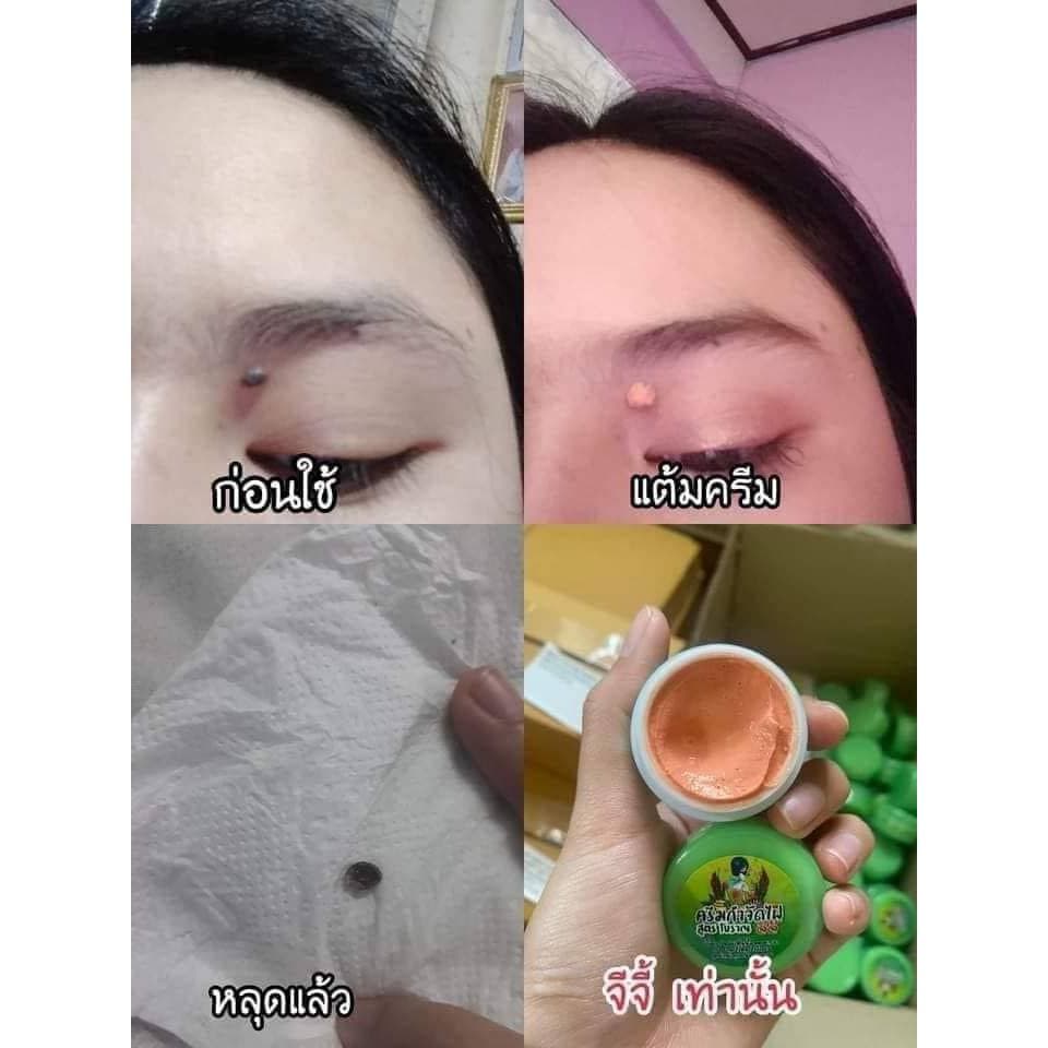 ครีมไฝจีจี้ ขี้แมลงวัน ติ่งเนื้อ หูด ตาปลา แก้ปัญหา กระ สิวหิน ครีมแต้มไฝจีจี้ไฝ หูด จี้ไฝ แต้มไฝ หูดติ่งเนื้อ รูปที่ 5