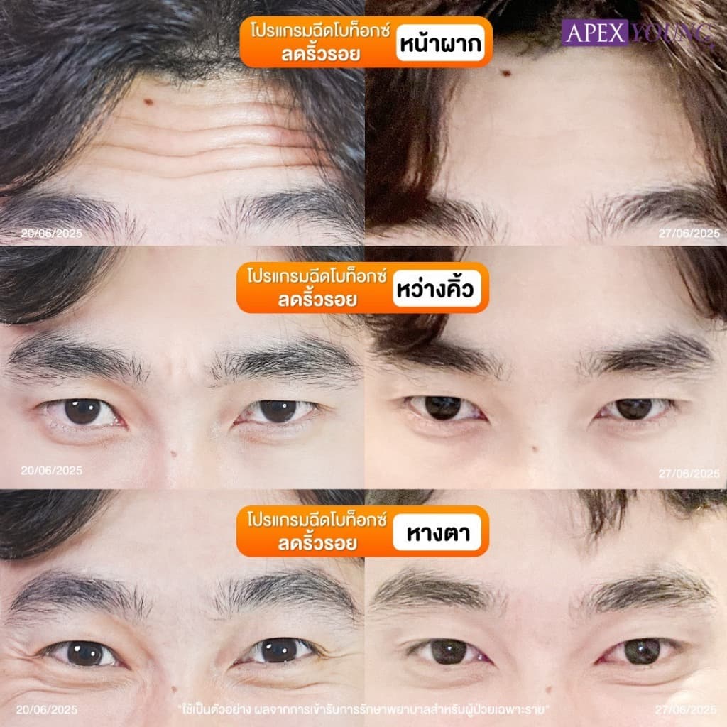 APEX โปรแกรมBo โบท็อกซ์ ลดกราม ลดริ้วรอย ลิฟต์กรอบหน้า 50U + ultraformer หน้าเรียว X2 รูปที่ 5