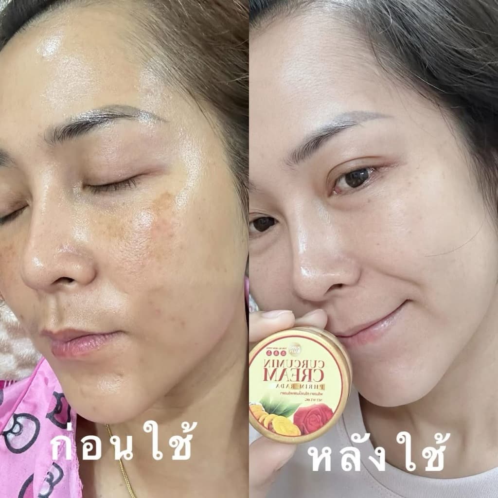 ครีมขมิ้นกุหลาบสด CURCUMIN CREAM บอกลาฝ้าหนาลึก กระ จุดด่างดำ บำรุงผิวหน้า รูปที่ 7