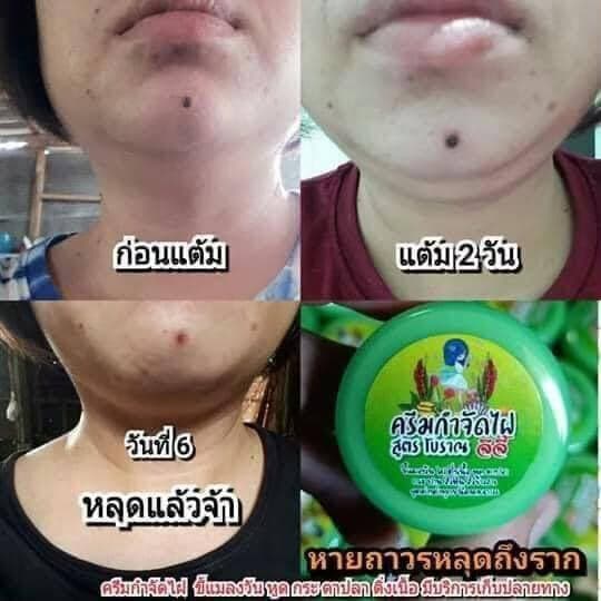 ครีมไฝจีจี้ ขี้แมลงวัน ติ่งเนื้อ หูด ตาปลา แก้ปัญหา กระ สิวหิน ครีมแต้มไฝจีจี้ไฝ หูด จี้ไฝ แต้มไฝ หูดติ่งเนื้อ รูปที่ 4