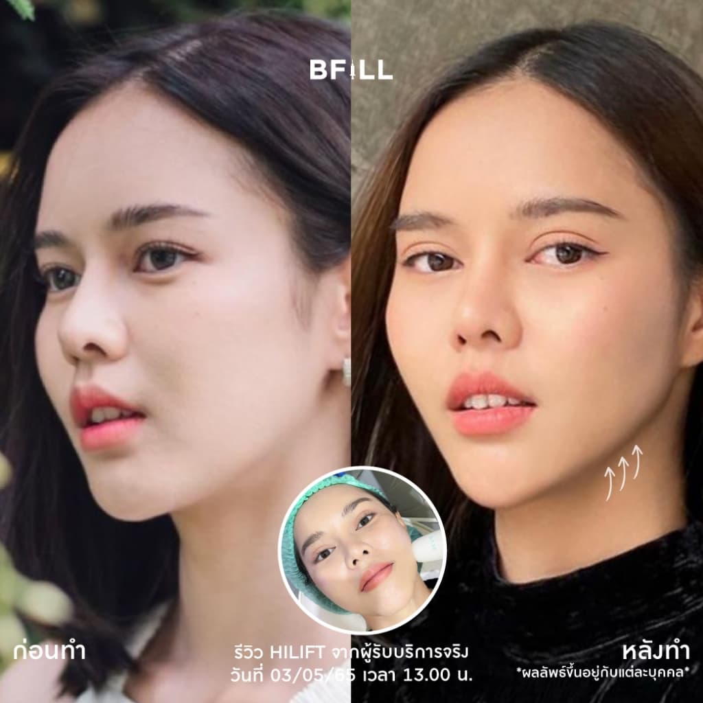 โปรแกรม Hi Lift ไฮลิฟท์ by Specialist ลดแก้มป่อง, กรอบหน้าชัด | BFiLL Clinic บีฟิล คลินิก รูปที่ 2