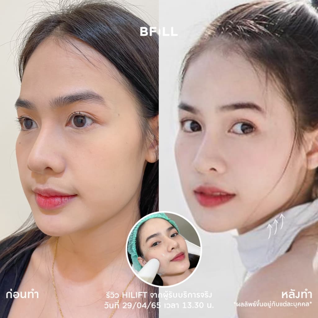 โปรแกรม Hi Lift ไฮลิฟท์ by Specialist ลดแก้มป่อง, กรอบหน้าชัด | BFiLL Clinic บีฟิล คลินิก รูปที่ 3